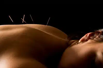 Acupuncture Approaches